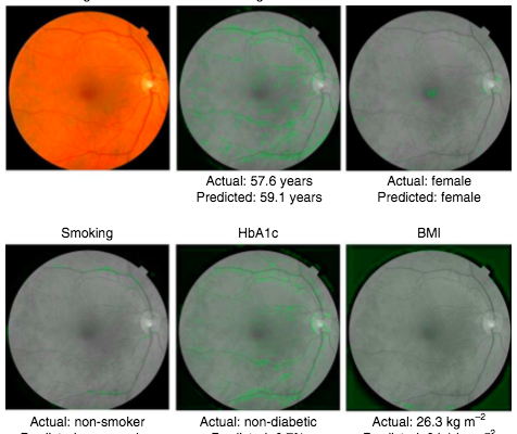 google retina previsione rischi malattie